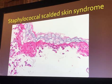 Staphylococcal Scalded Skin Syndrome Histology