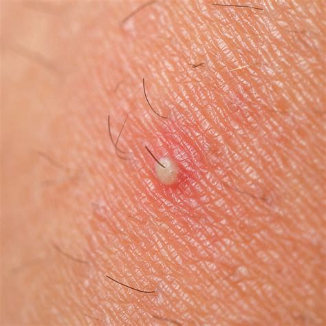 The Complete Guide to Ingrown Hairs - Lane44 – Lane 44