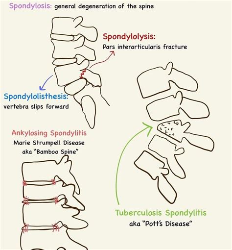 Spondylosis Vs Spondylolisthesis