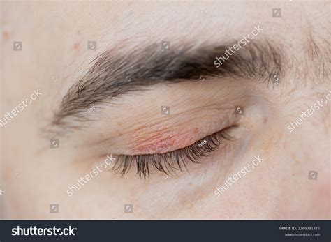 Types Of Eyelid Bumps – Eyelid Problems Symptoms – GMLYP
