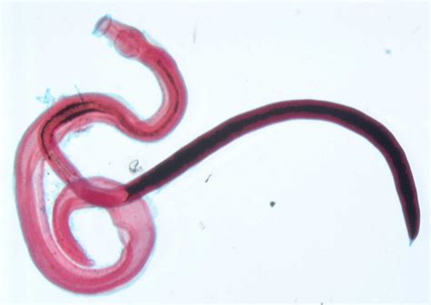 Schistosomiasis causes, symptoms, diagnosis, prevention &andtreatment
