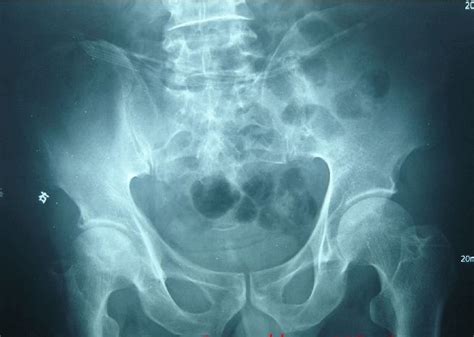 X光片解读股骨头坏死各类分期方法 - 好大夫在线