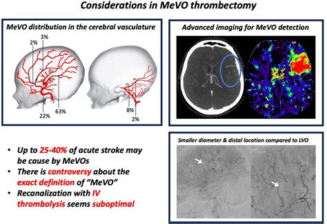 Endovascular Treatment of Medium Vessel Occlusion Stroke | Stroke