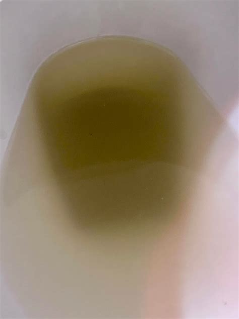 Just peed this out. What is it??? Cloudy, particles in urine please doctors can’t figure it out ...