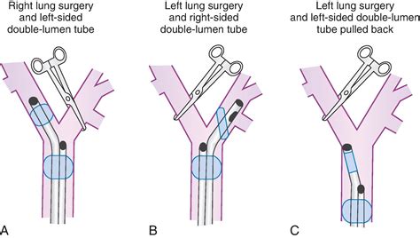 Clamping Double Lumen Tube at Daniel Gilmore blog