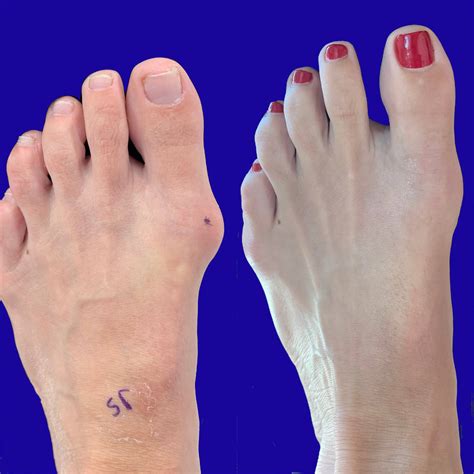 Types Of Bunion Surgery at Sophie Catani blog