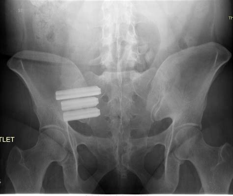 Sacroiliac Joint Fusion Using Triangular Titanium Implants vs. Non-Surgical Management: Six ...