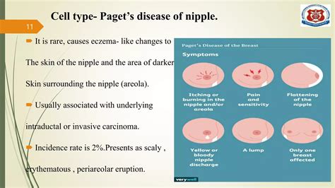 breast cancer ppt.pptx
