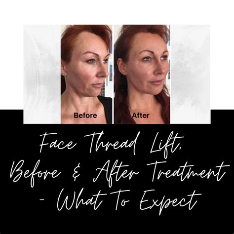 Face Thread Lift Before & After