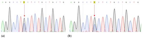 Whole Exome Sequencing Study Suggests an Impact of FANCA, CDH1 and ...
