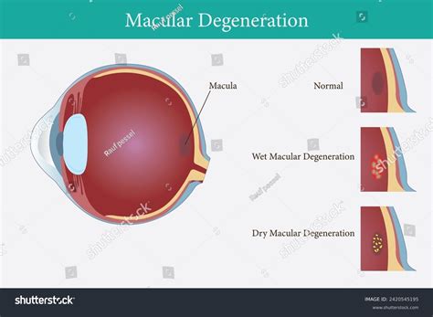 Vision Disorder 的图像结果
