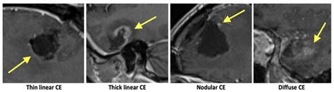 Timing of Early Postoperative MRI following Primary Glioblastoma ...
