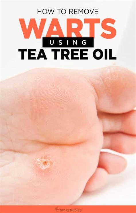Image result for tea tree oil warts