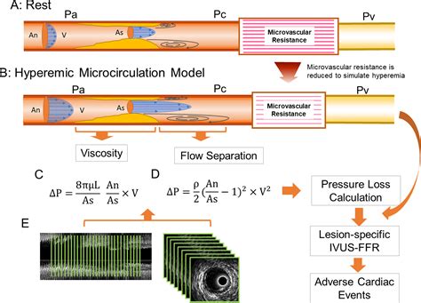 Impact of Intravascular Ultrasound–Derived Lesion-Specific Virtual Fractional Flow Reserve ...