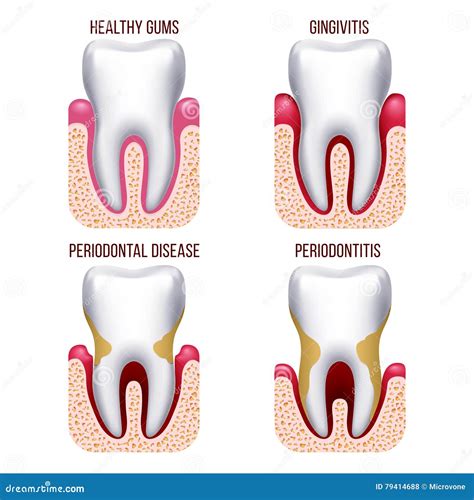 Human Gum Disease, Gums Bleeding. Tooth Prevention Dental, Oral Care Vector Infographics Stock ...