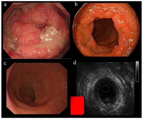 Cytomegalovirus Proctitis Developed after COVID-19 Vaccine: A Case ...