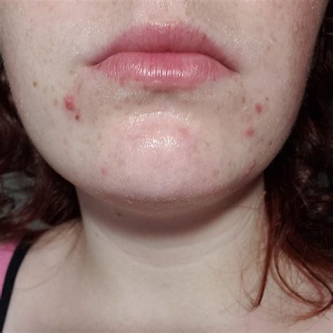 [Acne] Always gotten breakouts around my mouth and chin, despite a ...