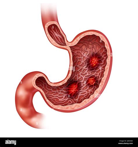 Gastric Ulcer