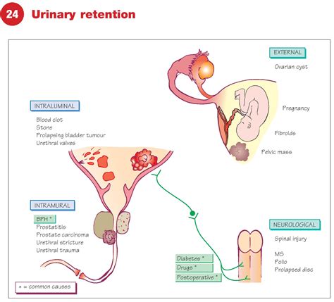Urinary Retention - Causes, Diagnosis, and Treatment