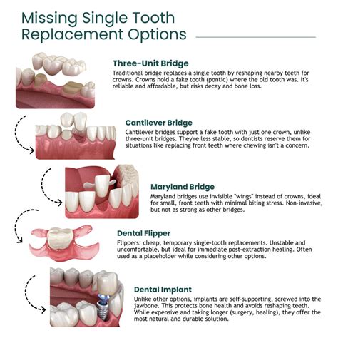 Missing Single Tooth Replacement Options | Riverside Oral Surgery