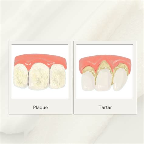 What Is Dental Plaque? Causes, Symptoms, & How To Remove It
