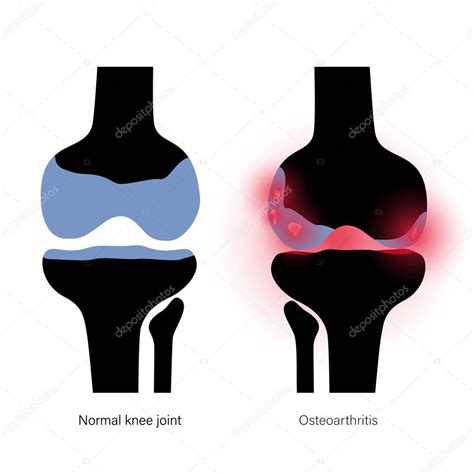 Artritis en la articulación de rodilla 2025