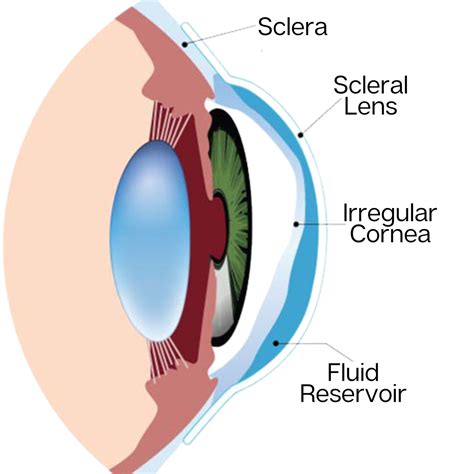 What Are Scleral Contact Lenses at Lilian Knopwood blog