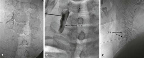 Image result for L4 Selective Nerve Root Block