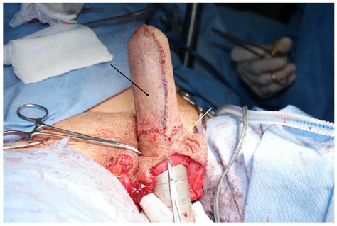 Tissue Options for Construction of the Neovaginal Canal in Gender ...