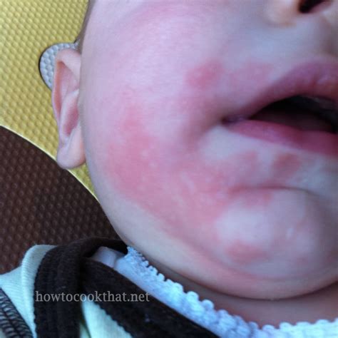 Rash Around Lips Food Allergy | Lipstutorial.org
