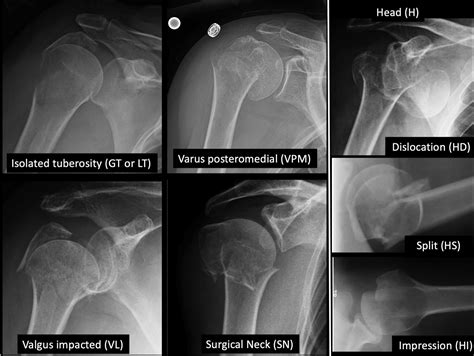 Classification of proximal humerus fractures according to pattern ...