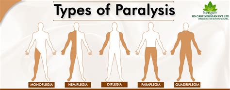 Paralysis 的图像结果