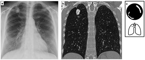 Calcified Lung Nodules: A Diagnostic Challenge in Clinical Daily Practice