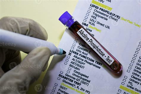 Alkaline Phosphatase - Test with blood sample. Top view isolated on office desk. Healthcare ...