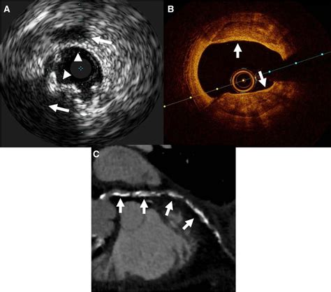 Coronary Artery Calcification: Current Concepts and Clinical ...