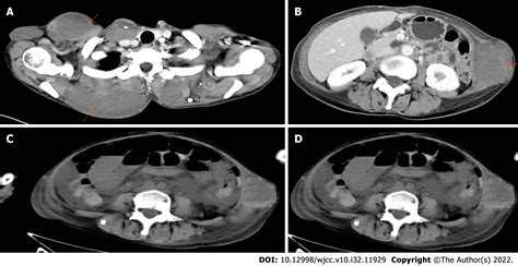 Blue rubber bleb nevus syndrome complicated with disseminated ...