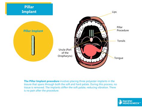 Pillar Implants - Snoring & Sleep Apnea - Pacific Head & Neck
