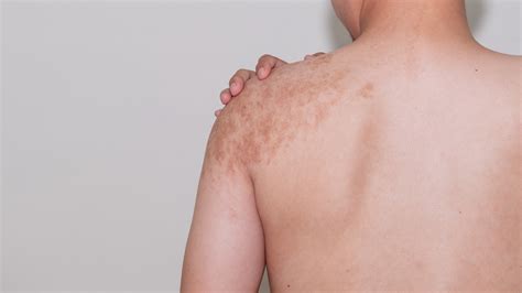Brown Spots on Skin - FCP Dermatology