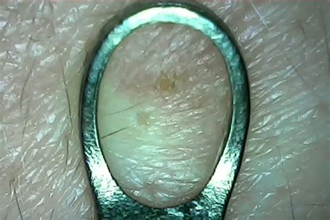 Image result for Back Full of Exploding Cysts