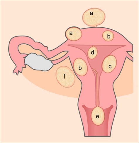 6 Types of Uterine Fibroids and Symptoms Explained - YouMeMindBody