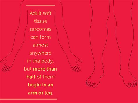 Signs and Symptoms of Soft Tissue Sarcomas | Dana-Farber Cancer Institute