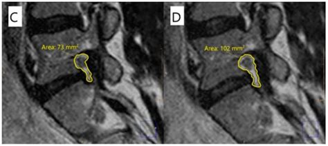 Associations between Patient Report of Pain and Intervertebral Foramina ...