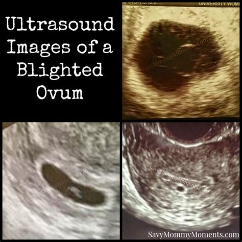 Blighted Ovum Miscarriage Process