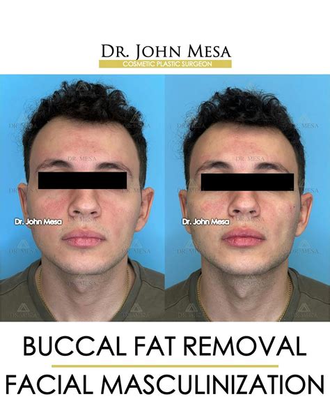 Facial Masculinization Before & After Photos | Dr. Mesa