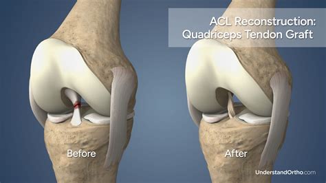 Acl Surgery Quad Graft Recovery at Alyssa Hobler blog