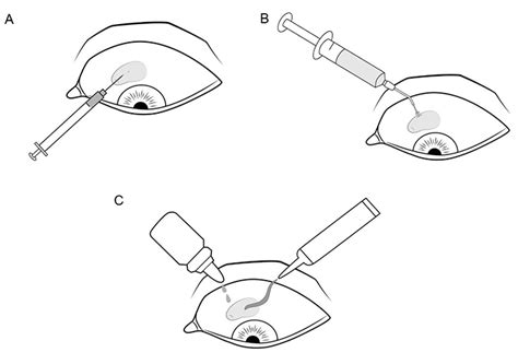 Subconjunctival Injection 的图像结果