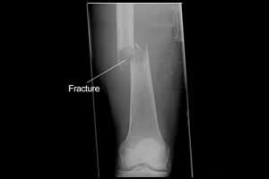 Ultrasound - A better tool than X-ray for diagnosing long-bone fracture ...