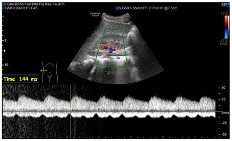 Renal Artery Stenosis and Mid-Aortic Syndrome in Children—A Review