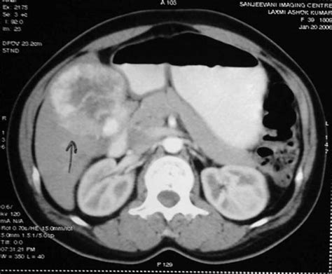 Liver Surgery Pictures, Images | LPC Mumbai