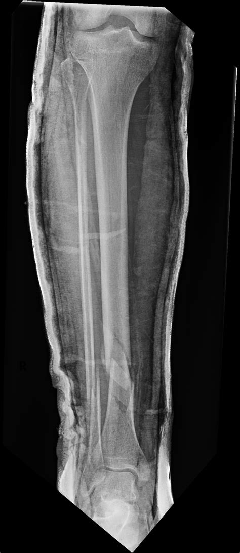 Tib/fib fracture X-rays from last month, beware of rollerskating! : r/brokenbones